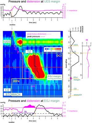 Characterizing Esophageal Motility in Neonatal Intensive Care Unit Patients Using High Resolution Manometry